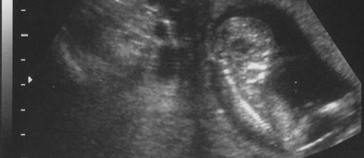 An ultrasound image